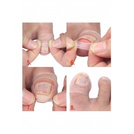 Shelax 1 Pair Silicone Ingrown Toenail Correction Tool Invisible Ingrown Toe Nail Care Elastic Straightening Clip Brace