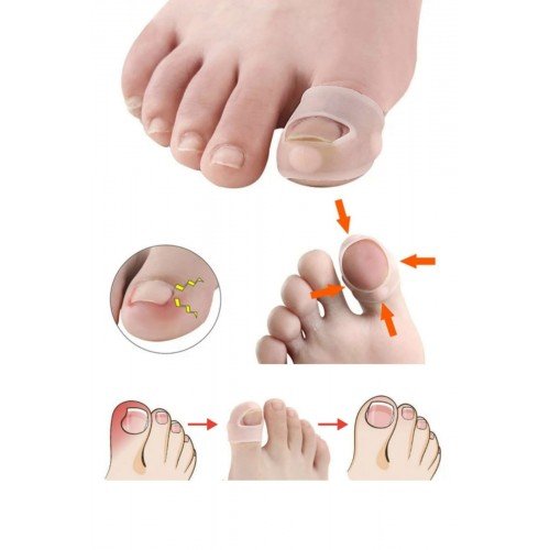 SHELAX Batık Tırnak Düzeltme Aleti Batık Tırnak Çıkartıcı Aparat Batık Tırnak Aleti 1 Çift